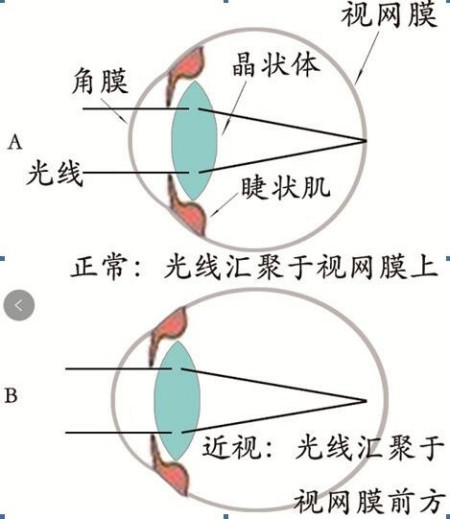 真性近视能治好吗