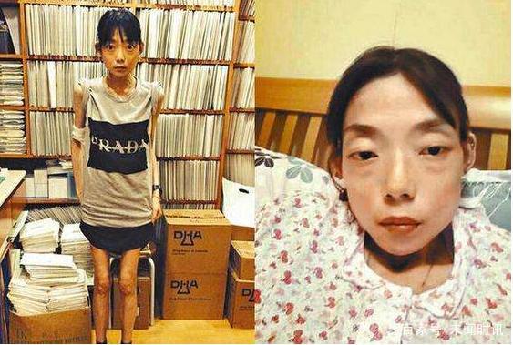 名模伍智恒八年内切割肠胃，全身瘫痪如怪物，如今又怎样了？