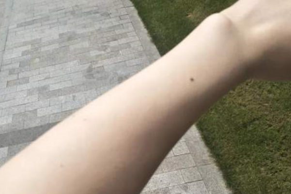 脸上的淤青怎么快速消除？